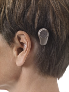 A bone-anchored hearing aid sends sound through the bones instead of through air.