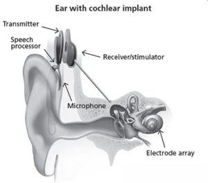 An ear with a cochlear implant 